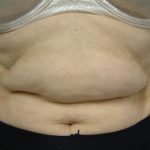 Unwanted Fat Kent | Excess Fat Kent | Stubborn Fat Kent