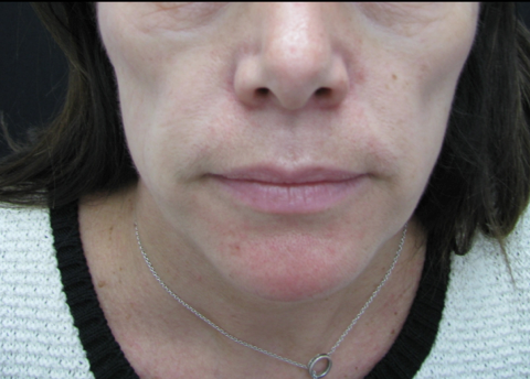 Picture showing hollowing of cheeks from cheek volume loss