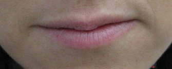 Lip Fillers Kent | Plump Lips Kent | Enhanced Lips Kent