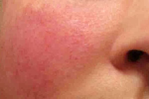 Rosacea Kent | Facial Redness Kent | Cheek Redness Kent