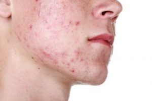 Acne is a common skin condition characterized by spots, oily skin, and sometimes painful or inflamed areas. It typically develops on the face, back, and chest. Acne is caused by blocked hair follicles, excessive sebum production, and bacteria. While often starting during puberty, acne can affect people of all ages.