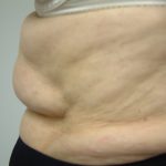 Excess Weight Kent | Stomach Fat Kent | Unwanted Fat Kent