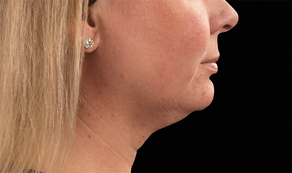 Double Chin Kent | Excess Fat Kent | Loose Skin Kent