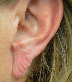 Ear Lobes Kent | Sagging Earlobes Kent | Stretched Earlobes Kent