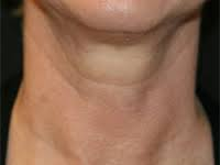 Neck Sagging Skin Kent | Neck Lines & Wrinkles Kent | Neck Jawline Kent