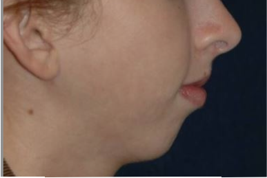 Picture showing a receeding chin