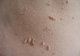 Skin Tags Kent | Face Skin Tags Kent Neck Skin Tags Kent