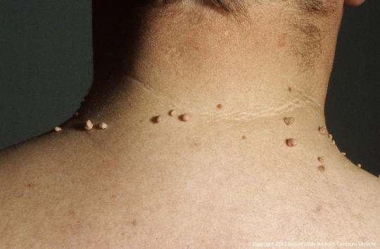 Skin Tags - Eyelids, Neck, Armpits, Groin, Breast | Kent