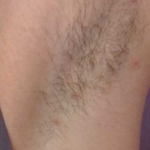 Unwanted Hair Kent | Hair Reduction Kent | Excessive Hair Kent