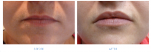 Dermal Fillers are a minimally invasive treatment that revitalise your face by filling the lines and wrinkles to restore volume lost in the skin