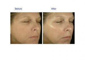 The Blue Peel Radiance is made up of 3 natural acids that give the skin a light superficial peel. It removes dead skin cells to reveal fresh, new, rejuvenated skin. This treatment can be for an instant skin pick me up