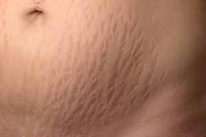 Stretch marks on stomach