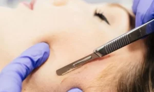 Dermaplaning treatment