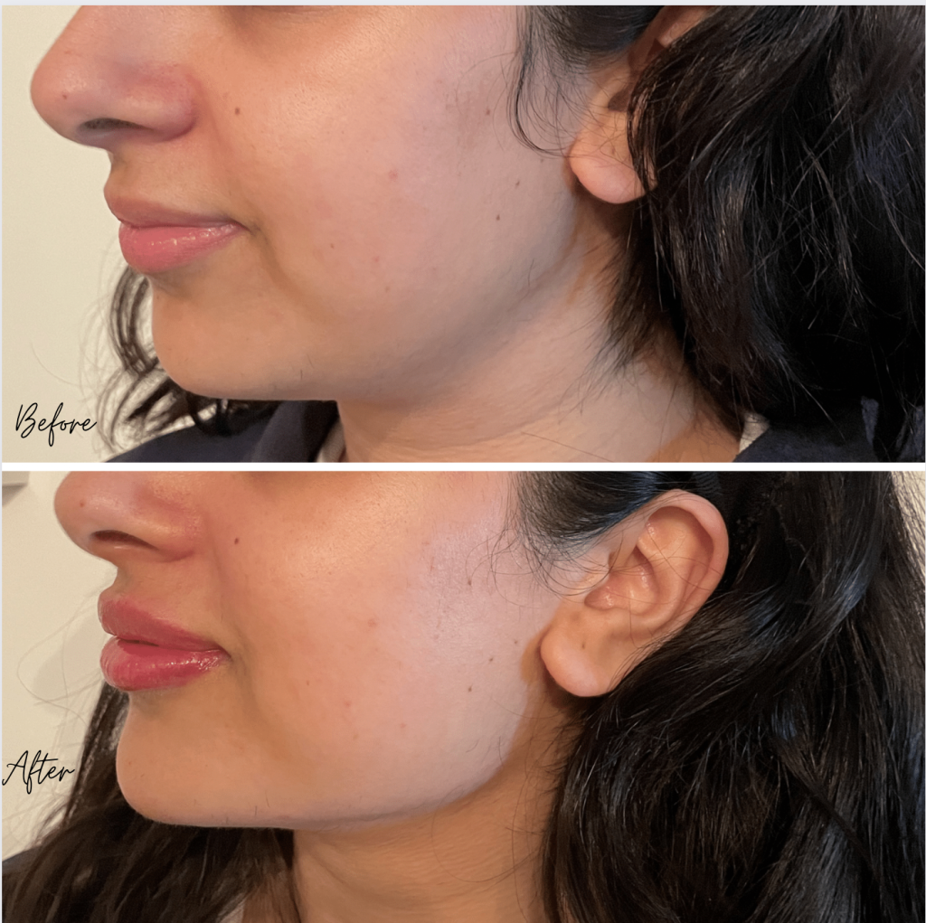 Before & after of jawline filler — Persona Medical Aesthetics, Skin & Laser Clinic