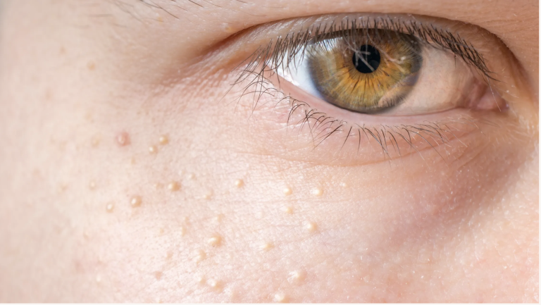 Milia is a common skin condition that causes small white bumps (cysts) under the surface of your skin.Milia (milk spots) are small, white cysts on your skin. Cysts are filled pockets under the surface of your skin. The most common place to find milia are on your face. Milia are harmless and only affect your appearance. It’s common to confuse the white bumps on your face with whiteheads, which are a type of acne. Milia aren’t a type of acne.