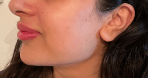 When the jawline loses its definition jowls develop causing the shape of the face to change and over time this can make both men and women look older. Sagging in the lower face is a sure indicator that the ageing process is taking place. This sagging is due to muscle laxity through the jaw line, causing the area to become less taunt and firm, which in turn causes the skin to droop