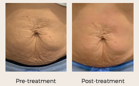 Skin tightening, hifu, liposhape pro persona medical aesthetics bexleyheath