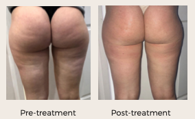 brazilian bum lift, liposhapre pro, cellulite treatment, persona medical aesthetic bexleyheath