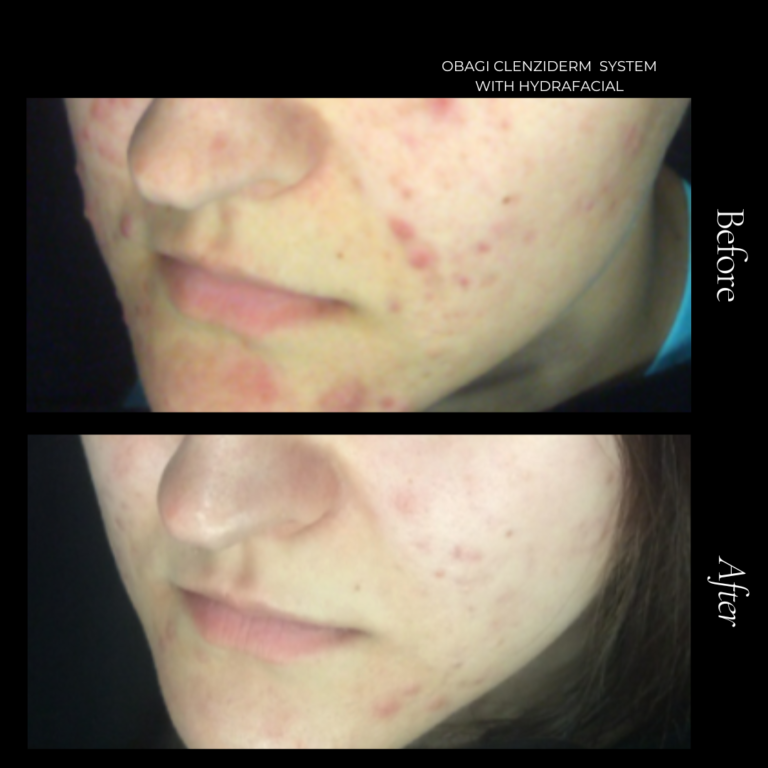 A complete 3-step system specifically formulated for normal to oily skin to treat acne where it starts. This system includes clinically proven benzoyl peroxide and salicylic acid to help control acne for a clearer, healthier-looking complexion. CLENZIderm M.D. System is ideal for acne-prone skin.