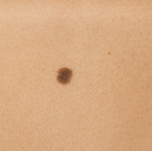 We are experts on all-things skin – including minor skin surgery. ‘Surgery’ can be an intimidating word, but rest assured, removing common lumps, bumps and blemishes are very straight forward simple procedures for us to perform and we have a lot of experience doing this. All treatments are carried out under local anaesthetic after which you can carry on life as normal, minus your troublesome friend.