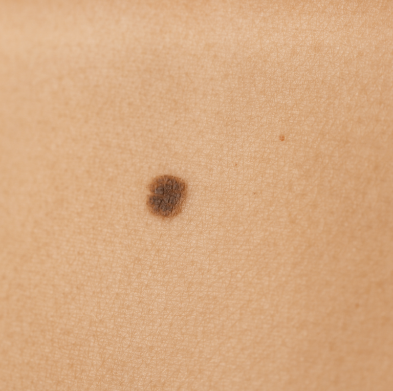 We are experts on all-things skin – including minor skin surgery. ‘Surgery’ can be an intimidating word, but rest assured, removing common lumps, bumps and blemishes are very straight forward simple procedures for us to perform and we have a lot of experience doing this. All treatments are carried out under local anaesthetic after which you can carry on life as normal, minus your troublesome friend.