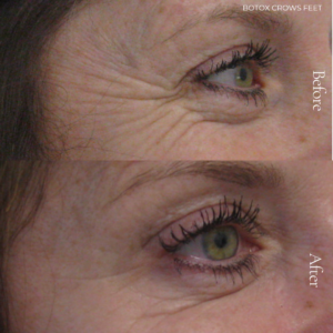 At Persona, we offer advanced Anti-Wrinkle injections to reduce the appearance of fine lines and soften expression lines. Our expertly delivered Botox treatments provide subtle, natural results.