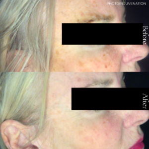 As we age our skin becomes more susceptible to damage due to hereditary conditions, sun and environmental exposure, and the natural ageing process. These factors result in an uneven skin tone, broken veins, and brown patches, dark freckles or sun spots. To target these concerns we use a photo rejuvenation system that combines IPL (intense pulsed light) and radio frequency to allow us to effectively fade and reduce the appearance of these skin imperfections.