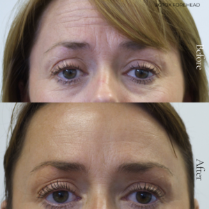 At Persona, we offer advanced Anti-Wrinkle injections to reduce the appearance of fine lines and soften expression lines. Our expertly delivered Botox treatments provide subtle, natural results.