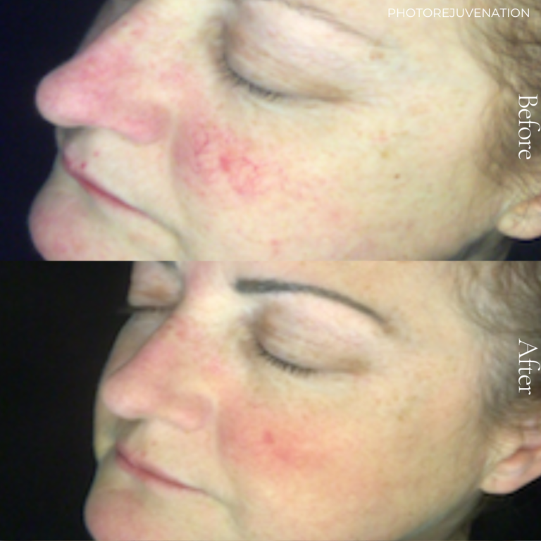 Laser skin rejuvenation Persona Medical Aesthetics