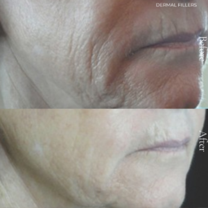 Dermal fillers are injectable treatments designed to restore lost volume, smooth out lines, and enhance facial contours. At Persona Medical Aesthetics, we use premium, hyaluronic acid-based fillers that closely mimic your skin’s natural moisture to deliver subtle, but noticeable results.