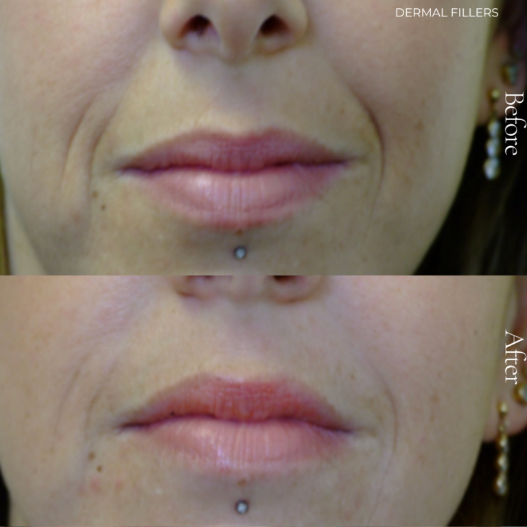 Dermal Fillers Before & After Persona Medical Aesthetics