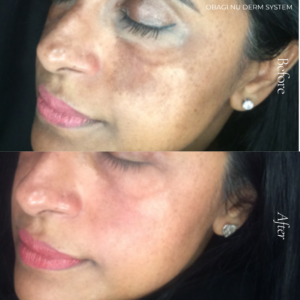Obagi Nu-Derm helps to transform your skin from the inside out with prescription 4% hydroquinone specially formulated for normal to oily skin. Skin aging is a natural process, but daily sun exposure can contribute to premature aging. Sun-damaged skin appears dull, with older, damaged skin layers accumulating due to slower skin cell turnover. The Obagi Nu-Derm System helps transform the skin’s appearance by reducing darks spots, revealing younger, healthier-looking skin