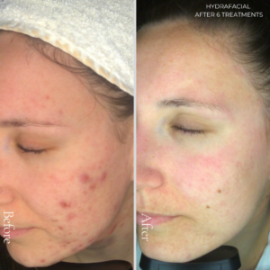 The original HydraFacial (including lymphatic drainage & LED light therapy) is a clinically proven, highly effective, medical facial, designed to work in the skin, rather than just on the skin. The philosophy is not just about improving the appearance, but about truly restoring youthful, healthy skin.
