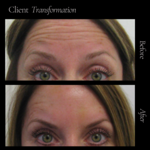 Anti-wrinkle injections, commonly known as Botox, are a quick and effective treatment for reducing fine lines and dynamic wrinkles. By relaxing underlying muscles, Botox softens existing lines that have been caused by repeated facial expressions, such as smiling and frowning, and it can help prevent new ones from forming. It’s extremely safe and virtually painless when administered by a trained and experienced medical professional.