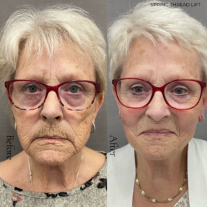 Spring Thread® is a cutting-edge, permanent thread lift developed in France. This innovative treatment uses specially designed biocompatible threads to lift and reposition sagging skin. Therefore offering a more youthful appearance. The threads are made from silicone and polyester—materials known for their safety and compatibility with body tissues.
