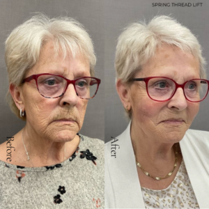 Spring Thread® is a cutting-edge, permanent thread lift developed in France. This innovative treatment uses specially designed biocompatible threads to lift and reposition sagging skin. Therefore offering a more youthful appearance. The threads are made from silicone and polyester—materials known for their safety and compatibility with body tissues.