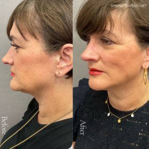 Spring Thread® is a cutting-edge, permanent thread lift developed in France. This innovative treatment uses specially designed biocompatible threads to lift and reposition sagging skin. Therefore offering a more youthful appearance. The threads are made from silicone and polyester—materials known for their safety and compatibility with body tissues.