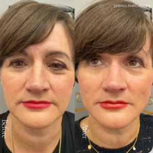 Spring Thread® is a cutting-edge, permanent thread lift developed in France. This innovative treatment uses specially designed biocompatible threads to lift and reposition sagging skin. Therefore offering a more youthful appearance. The threads are made from silicone and polyester—materials known for their safety and compatibility with body tissues.