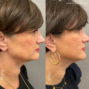Spring Thread® is a cutting-edge, permanent thread lift developed in France. This innovative treatment uses specially designed biocompatible threads to lift and reposition sagging skin. Therefore offering a more youthful appearance. The threads are made from silicone and polyester—materials known for their safety and compatibility with body tissues.