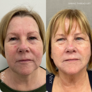 Spring Thread® is a cutting-edge, permanent thread lift developed in France. This innovative treatment uses specially designed biocompatible threads to lift and reposition sagging skin. Therefore offering a more youthful appearance. The threads are made from silicone and polyester—materials known for their safety and compatibility with body tissues.