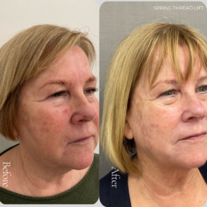 Spring Thread® is a cutting-edge, permanent thread lift developed in France. This innovative treatment uses specially designed biocompatible threads to lift and reposition sagging skin. Therefore offering a more youthful appearance. The threads are made from silicone and polyester—materials known for their safety and compatibility with body tissues.