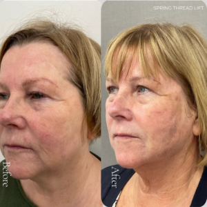 Spring Thread® is a cutting-edge, permanent thread lift developed in France. This innovative treatment uses specially designed biocompatible threads to lift and reposition sagging skin. Therefore offering a more youthful appearance. The threads are made from silicone and polyester—materials known for their safety and compatibility with body tissues.