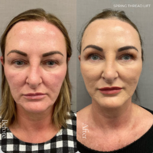 Spring Thread® is a cutting-edge, permanent thread lift developed in France. This innovative treatment uses specially designed biocompatible threads to lift and reposition sagging skin. Therefore offering a more youthful appearance. The threads are made from silicone and polyester—materials known for their safety and compatibility with body tissues.