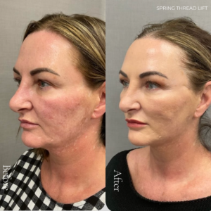 Spring Thread® is a cutting-edge, permanent thread lift developed in France. This innovative treatment uses specially designed biocompatible threads to lift and reposition sagging skin. Therefore offering a more youthful appearance. The threads are made from silicone and polyester—materials known for their safety and compatibility with body tissues.