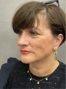 Spring Thread® is a cutting-edge, permanent thread lift developed in France. This innovative treatment uses specially designed biocompatible threads to lift and reposition sagging skin. Therefore offering a more youthful appearance. The threads are made from silicone and polyester—materials known for their safety and compatibility with body tissues.