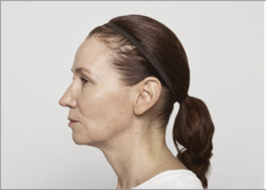 Sculptra offers a powerful solution by working with your body’s natural collagen production. Unlike traditional fillers that provide instant volume, Sculptra injections gradually rebuild your skin’s structure from within, delivering subtle, natural-looking results that improve over time.