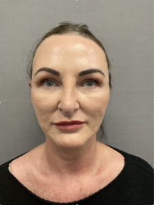 Spring Thread® is a cutting-edge, permanent thread lift developed in France. This innovative treatment uses specially designed biocompatible threads to lift and reposition sagging skin. Therefore offering a more youthful appearance. The threads are made from silicone and polyester—materials known for their safety and compatibility with body tissues.