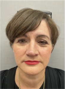 Spring Thread® is a cutting-edge, permanent thread lift developed in France. This innovative treatment uses specially designed biocompatible threads to lift and reposition sagging skin. Therefore offering a more youthful appearance. The threads are made from silicone and polyester—materials known for their safety and compatibility with body tissues.