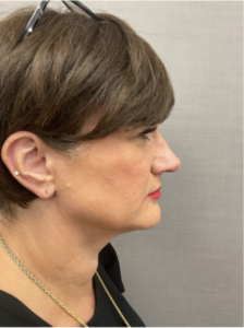 Spring Thread® is a cutting-edge, permanent thread lift developed in France. This innovative treatment uses specially designed biocompatible threads to lift and reposition sagging skin. Therefore offering a more youthful appearance. The threads are made from silicone and polyester—materials known for their safety and compatibility with body tissues.
