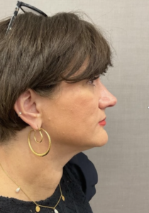 Spring Thread® is a cutting-edge, permanent thread lift developed in France. This innovative treatment uses specially designed biocompatible threads to lift and reposition sagging skin. Therefore offering a more youthful appearance. The threads are made from silicone and polyester—materials known for their safety and compatibility with body tissues.